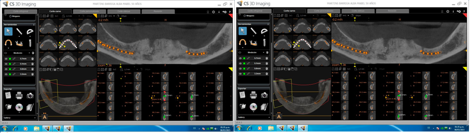 Tomografía Implantes